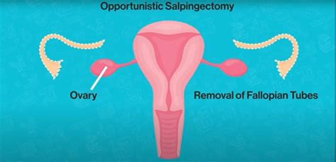 sex tubes|Oophorectomy (ovary removal surgery)